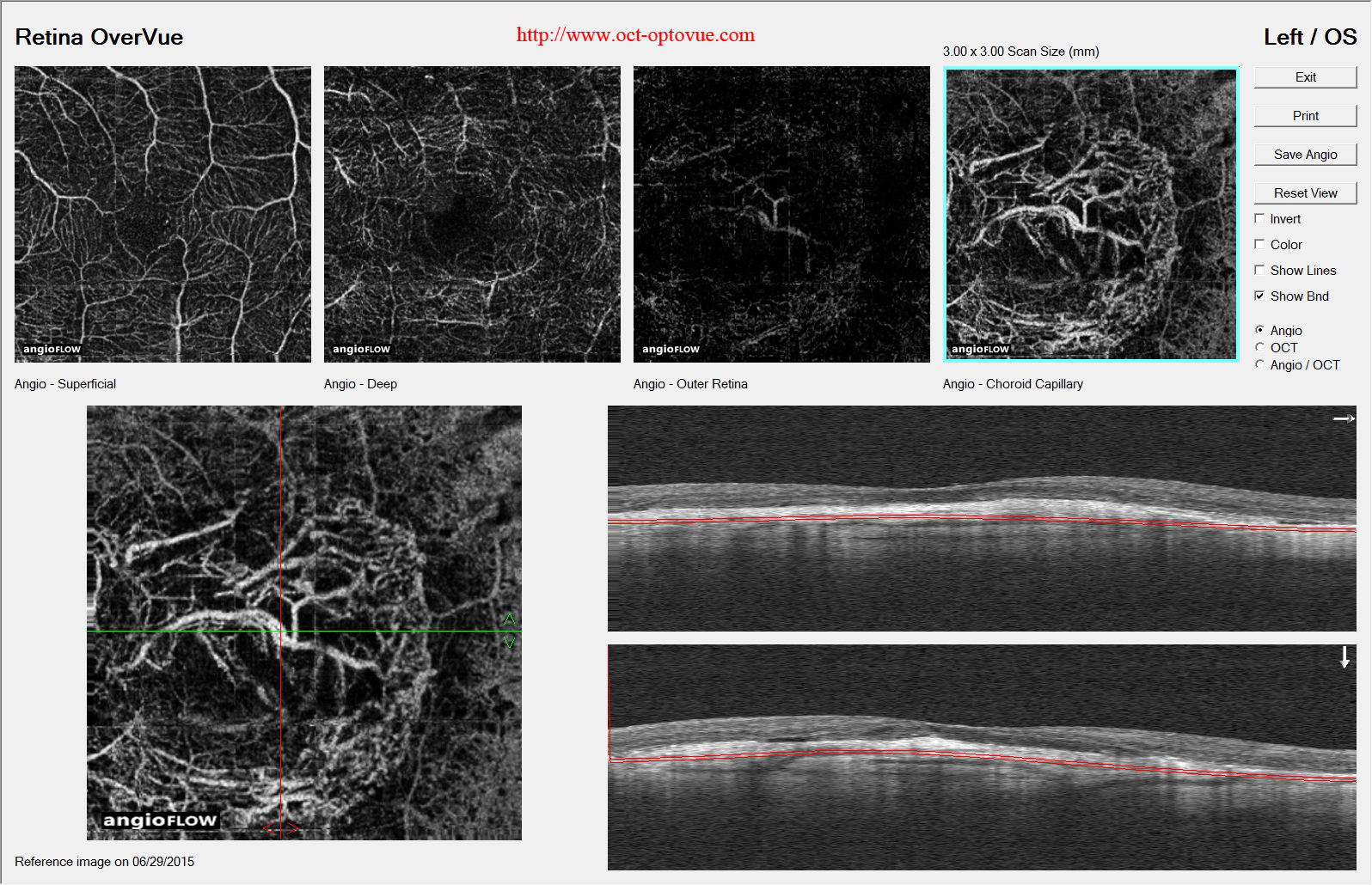 arterialisation post-antivegf retina optovue