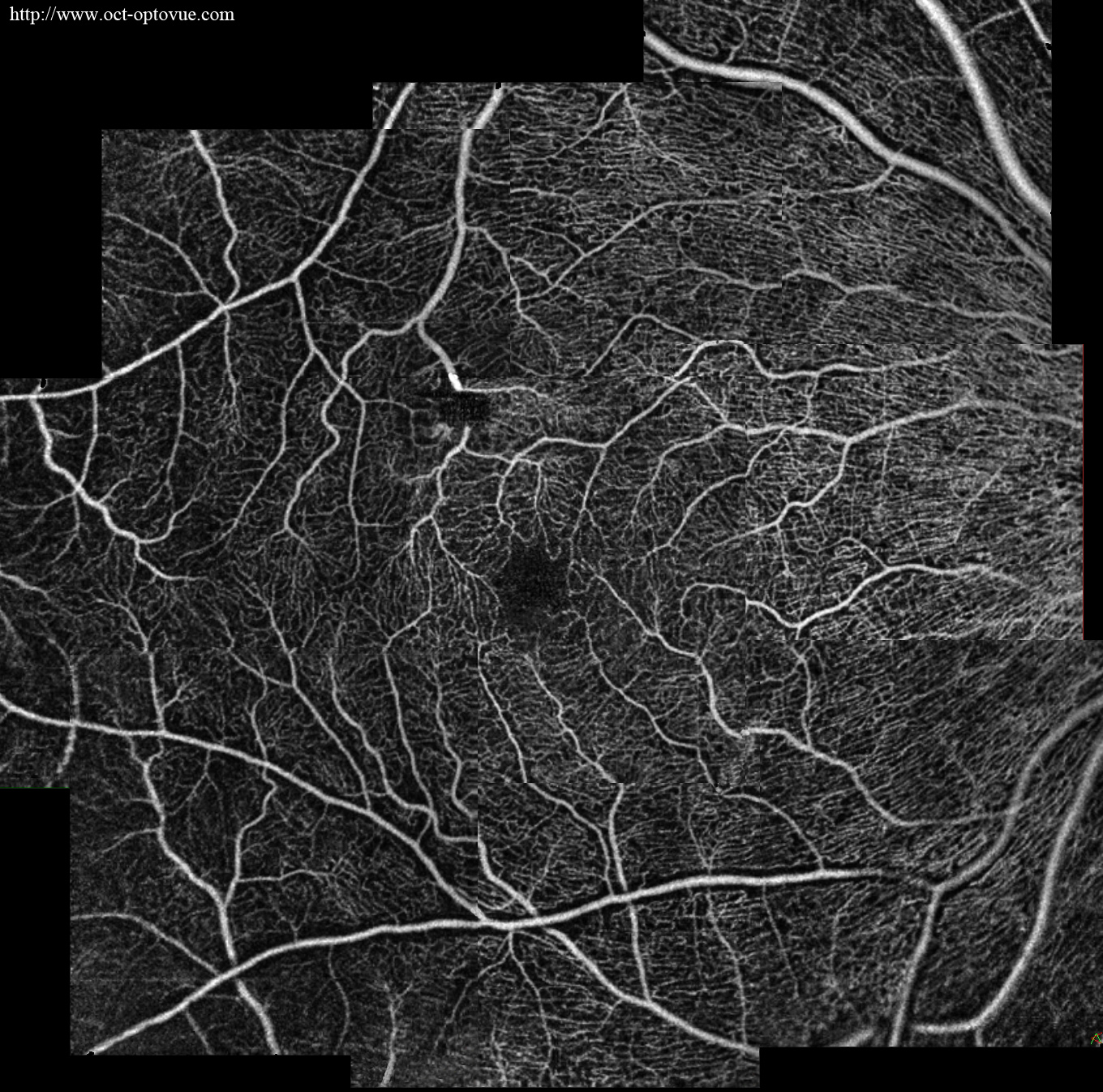 panoramic-cnv-octa recurrent cnv