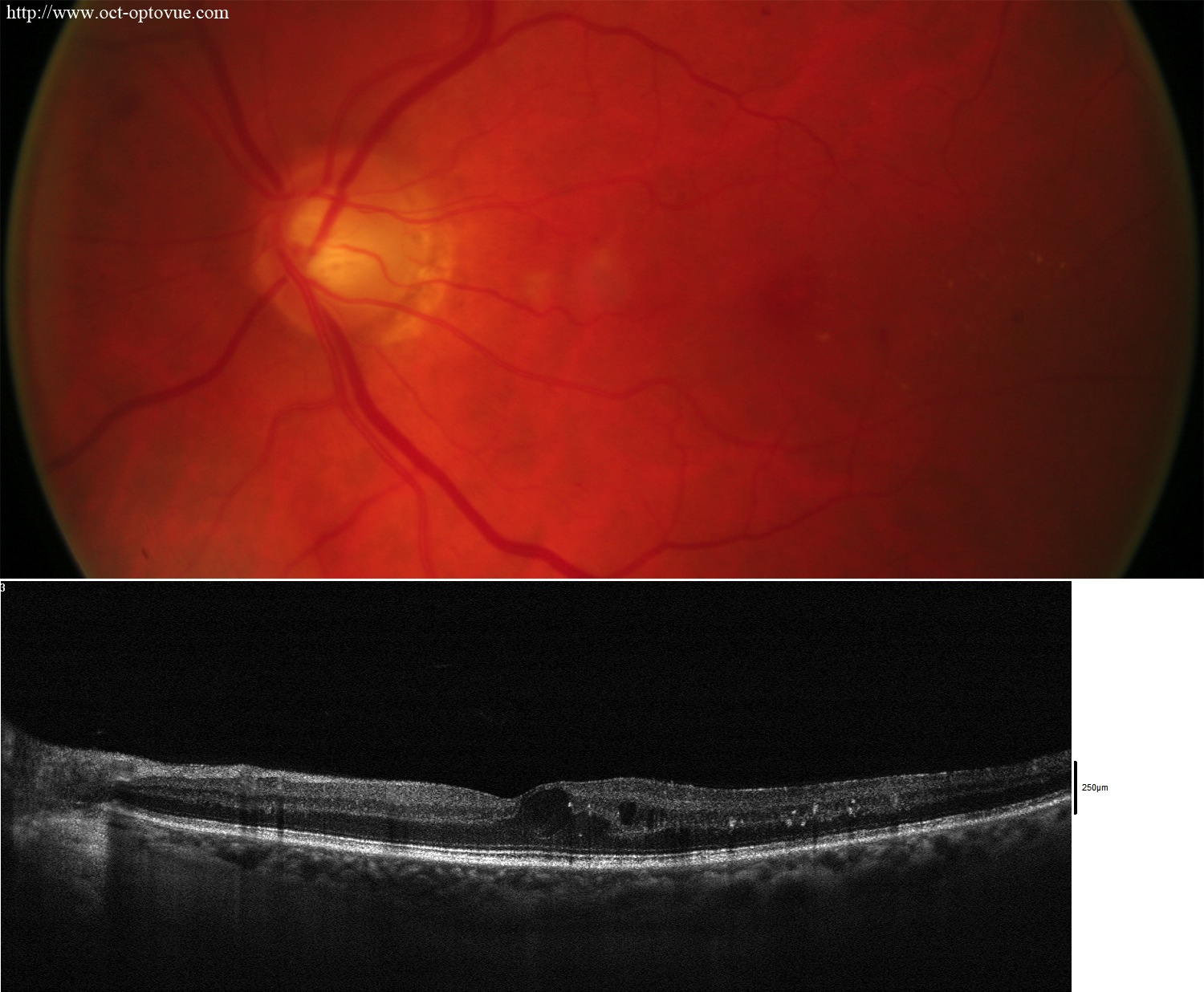 diabetes-octangio left eye