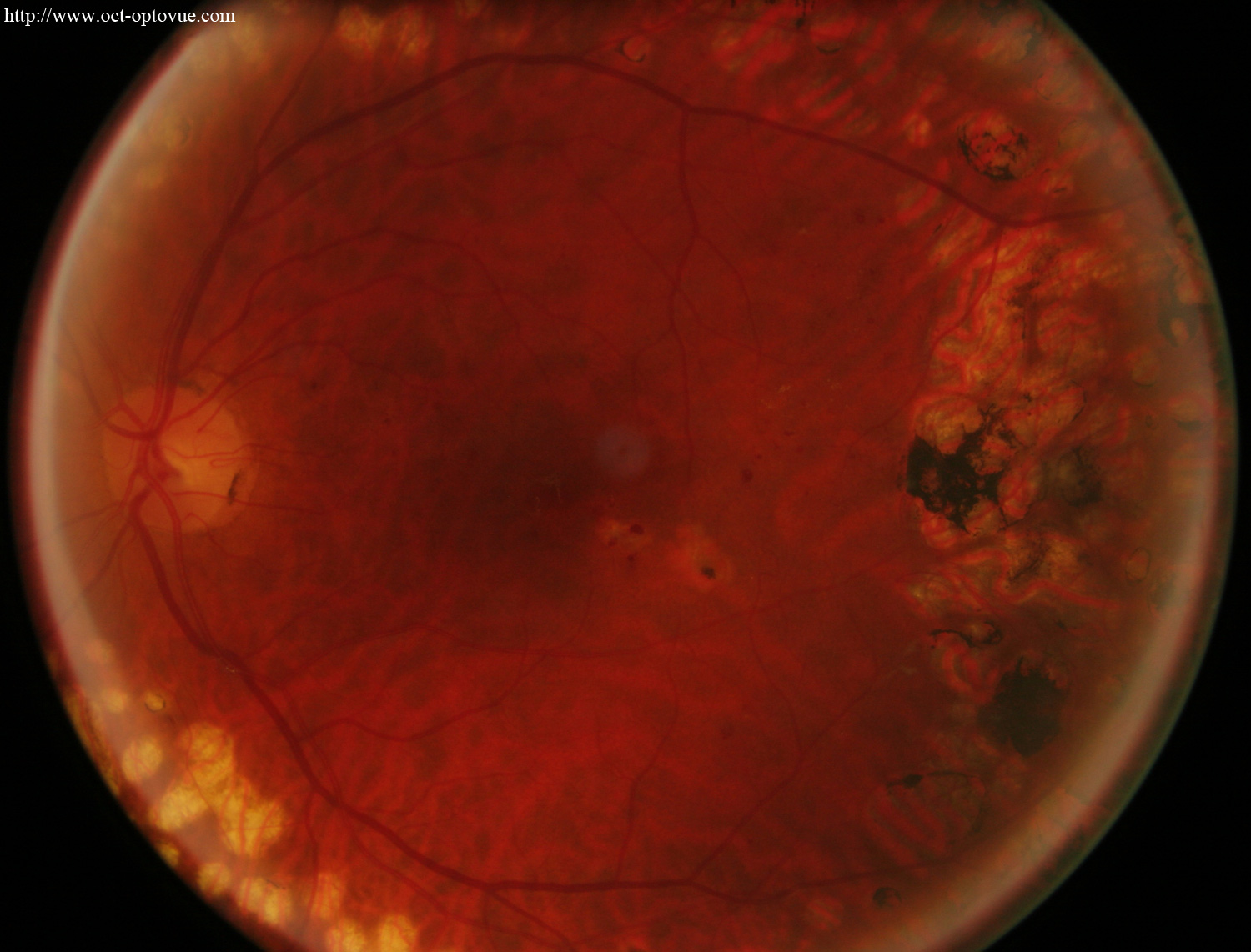 diabetes retina oedema