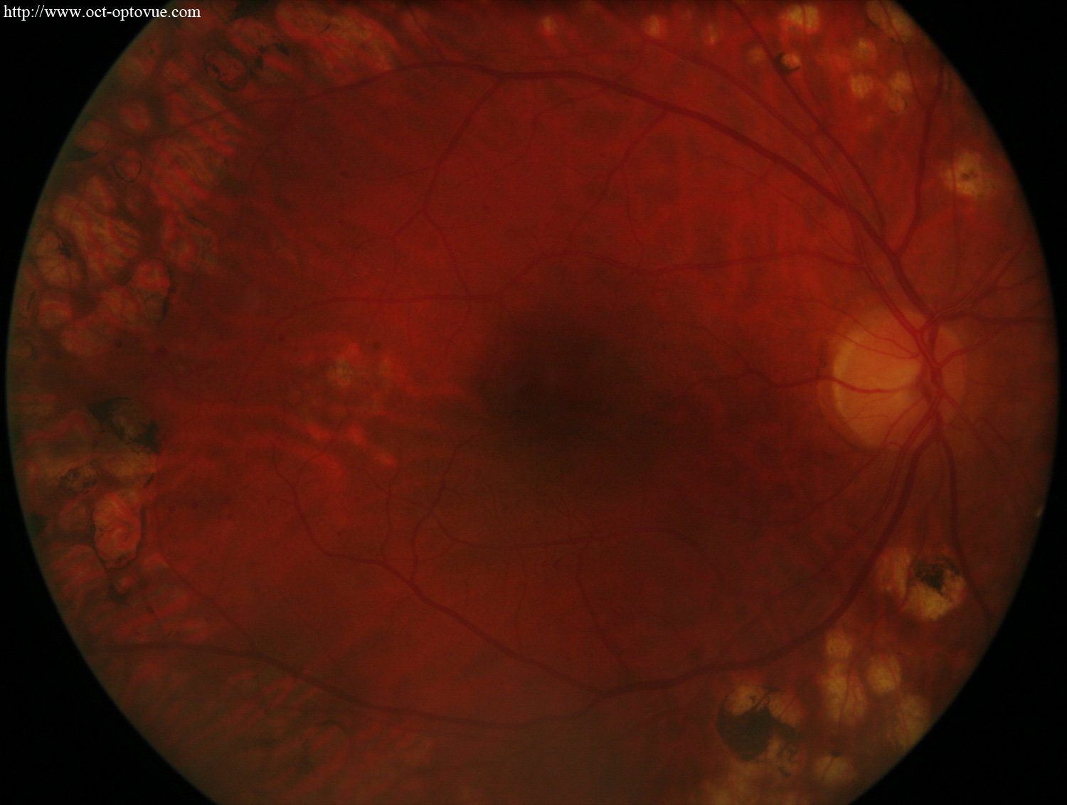 diabetes retina panphotocoagulation laser