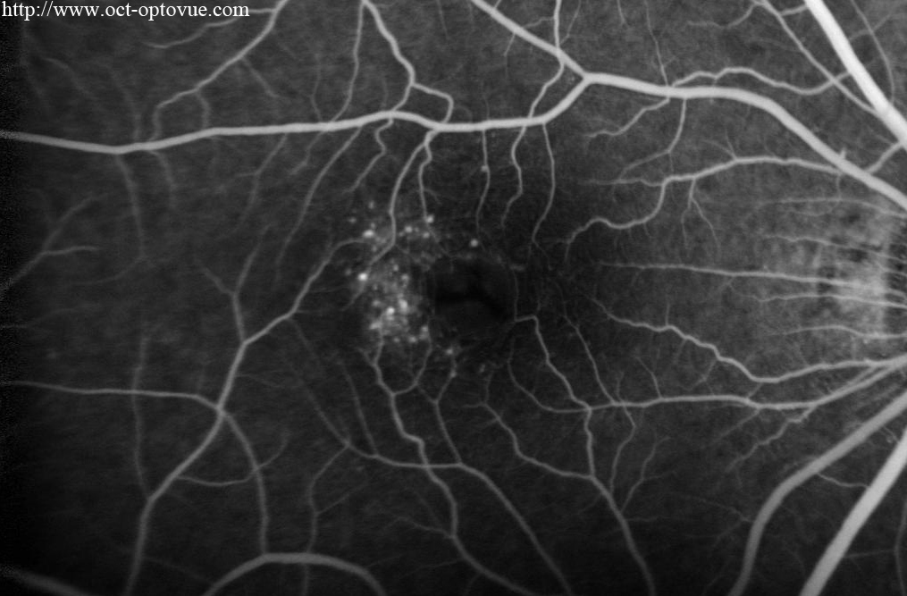 mactel1 angio fluo octangio retina coats