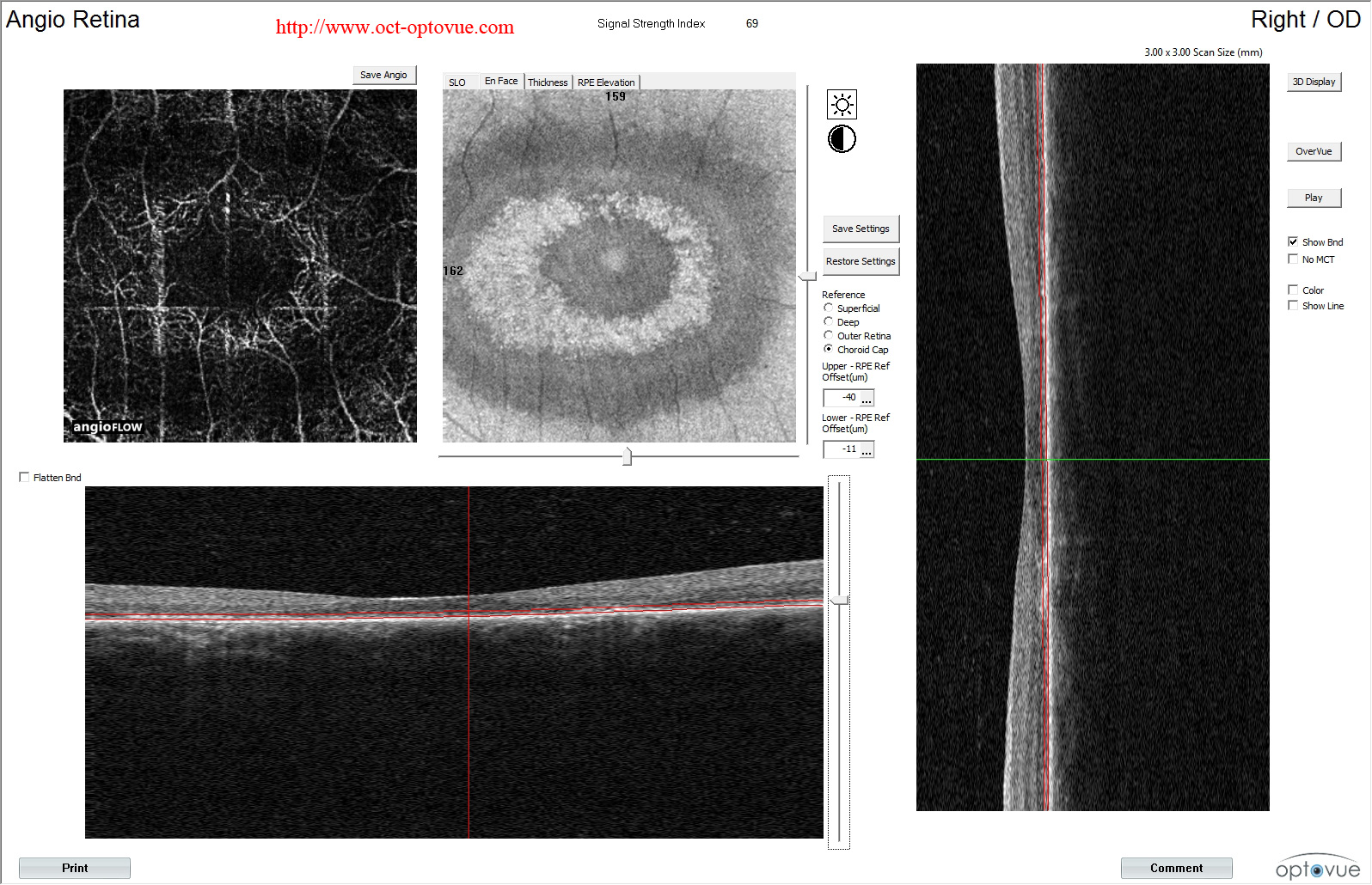 chloroquine maculopathy hydroxychloroquine angio oct