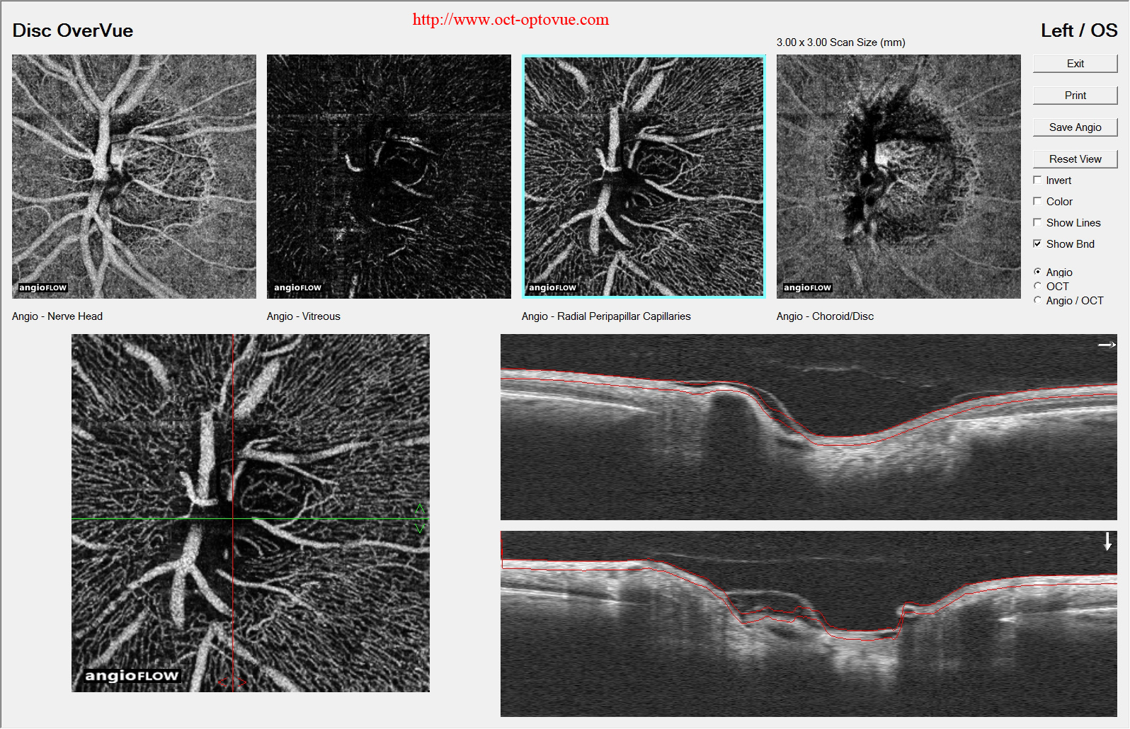 oct-angio optic disc normal