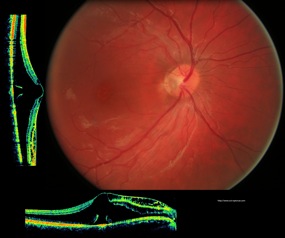 oct optic disc pit fossette colobomateuse dsr décollement séreux maculaire