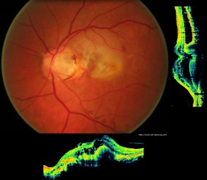 oct optic disc pit fossette colobomateuse néovaisseaux