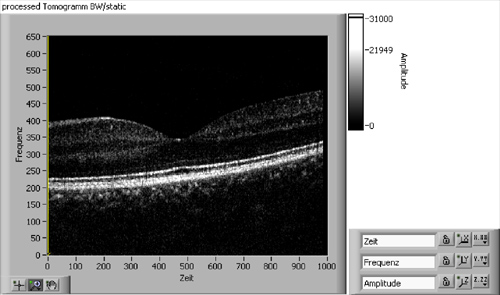 oct froelhy retina retine