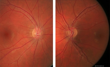 multiple sclerosis oct ms sep sclérose en plaques