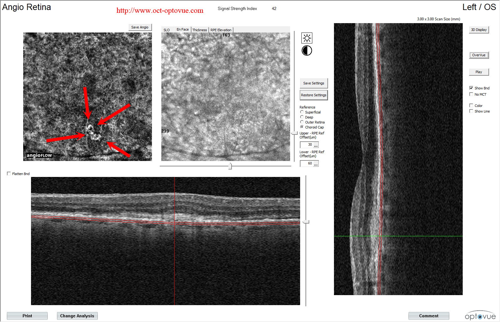 oct-angiography-amd-15