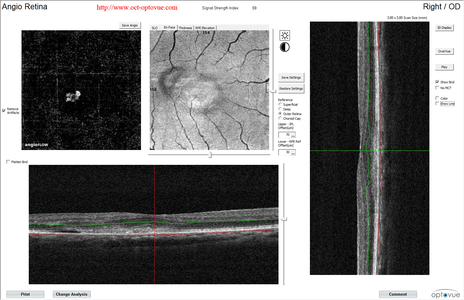 optovue amd oct angiography cnv