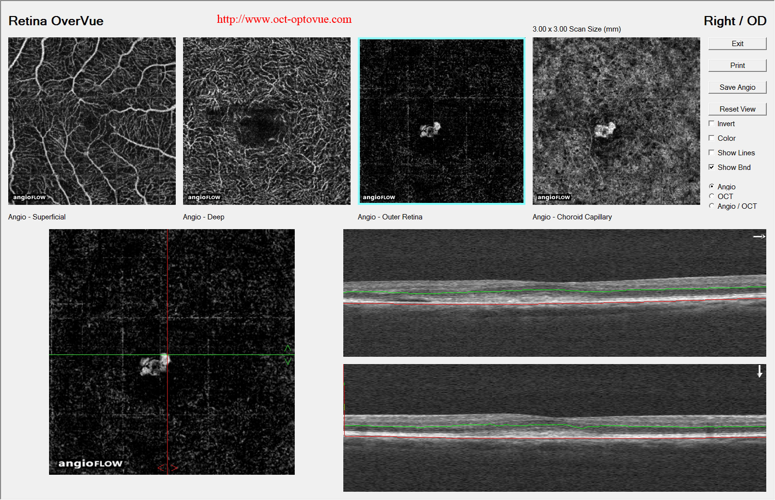 optovue amd oct angiography cnv