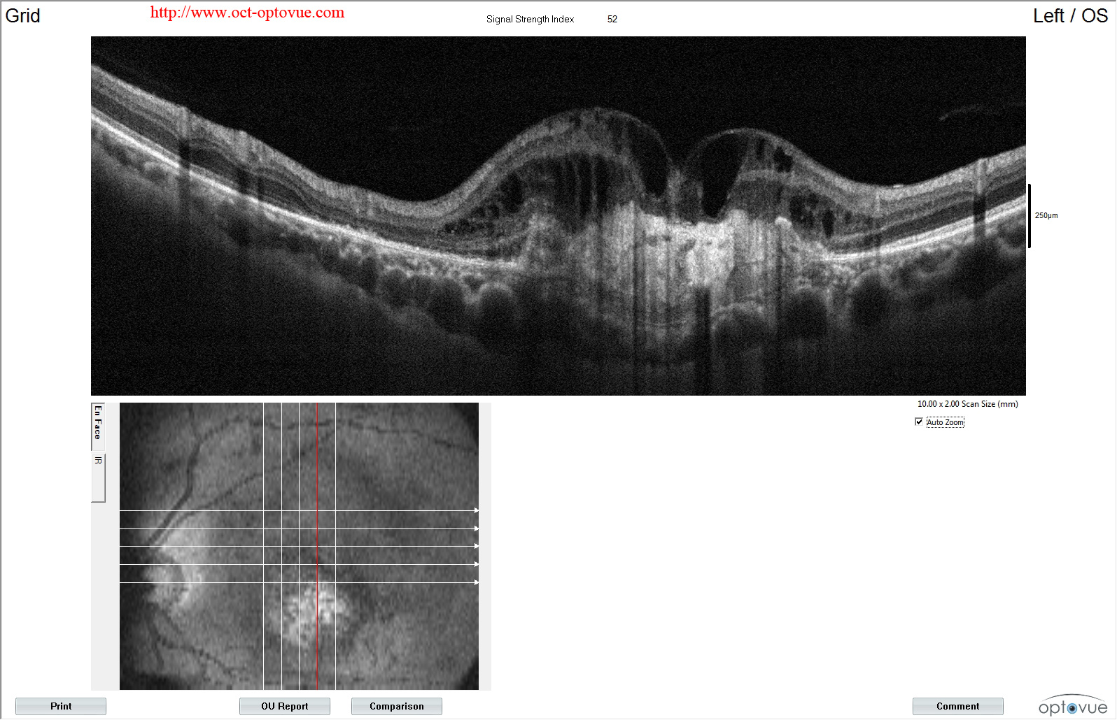 optovue amd bad oct too late