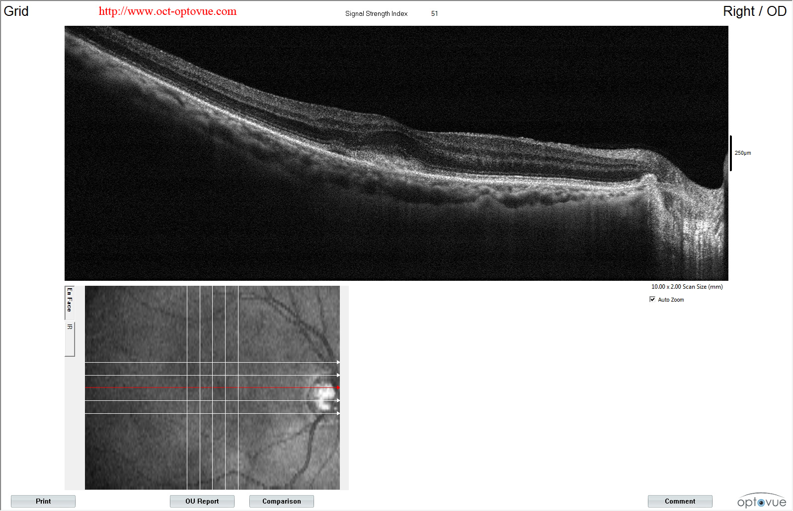 optovue amd oct angiography