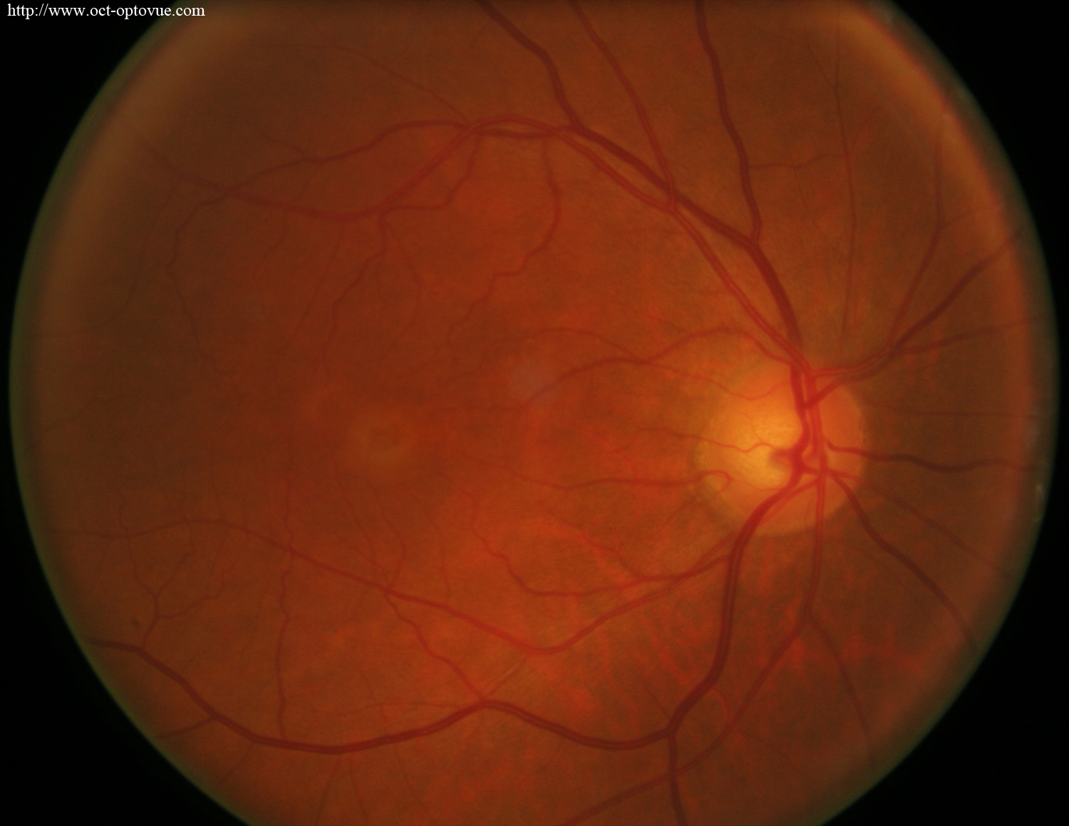 optovue amd oct angiography