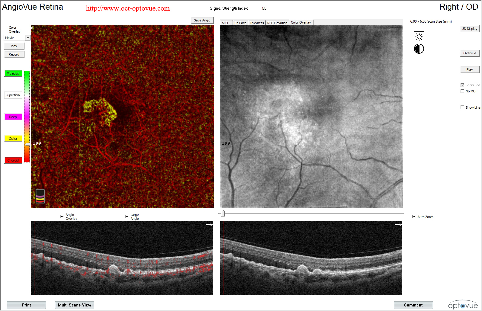 AMD color overlay oct angiography Optovue 