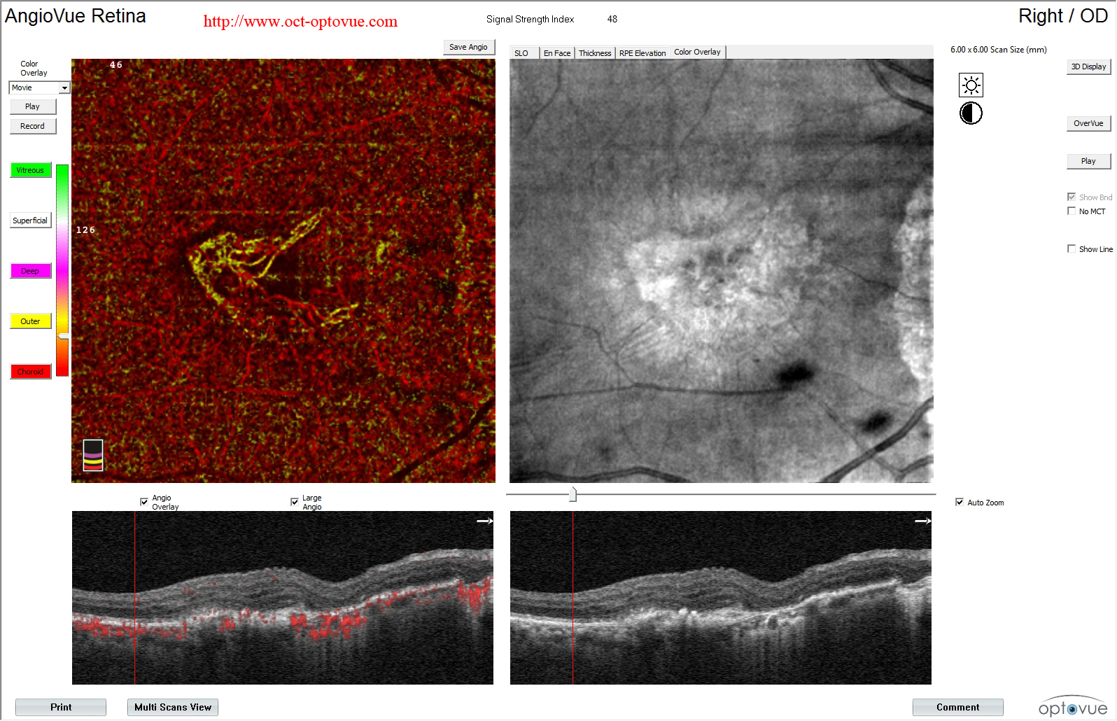 AMD color overlay octa from Optovue 