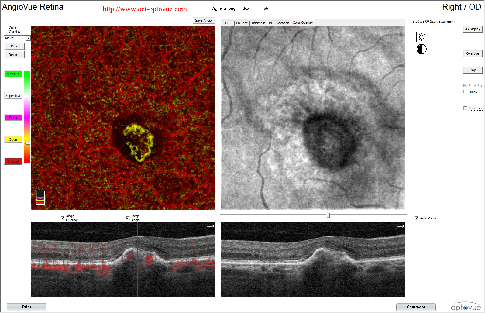 CNV color overlay oct angiography Optovue 