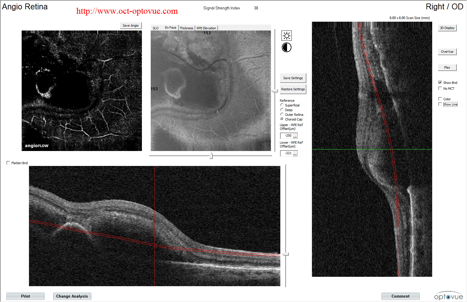 hemorrhage macula retina cnv angio fluo