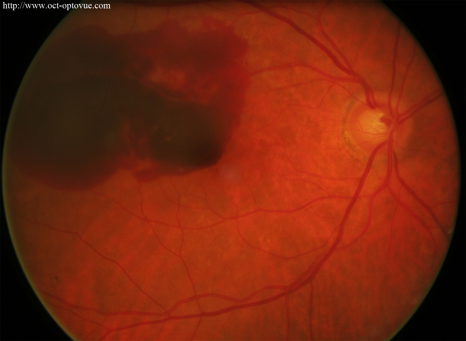 hemorrhage macula retina cnv angio