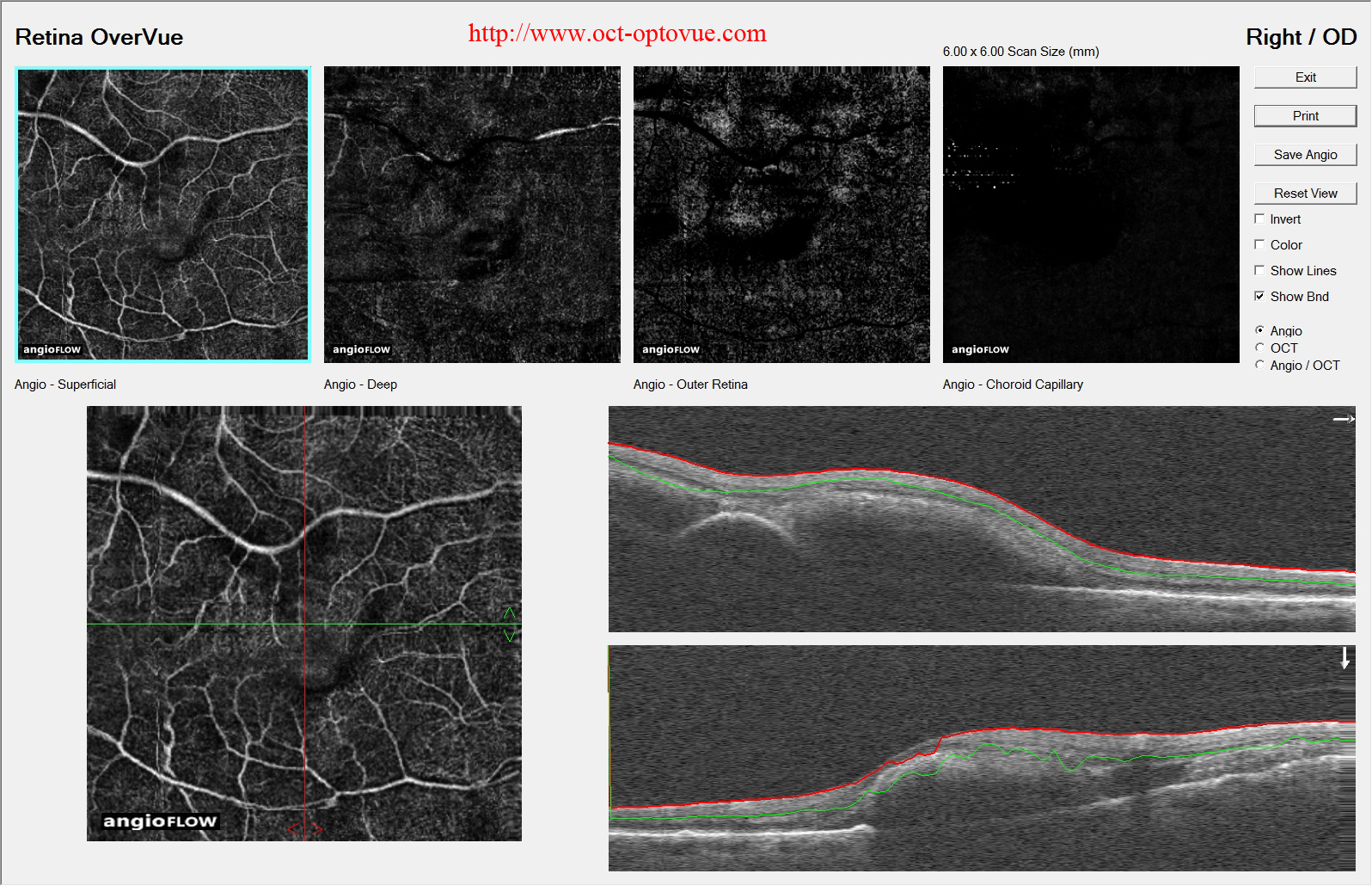 hemorrhage macula retina cnv angio