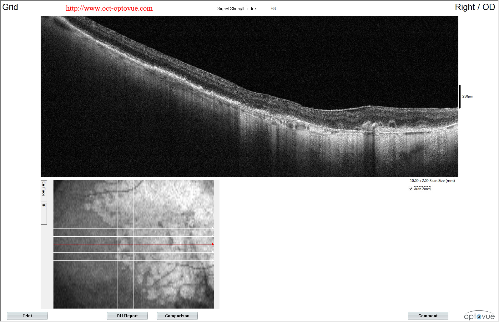 angio-atrophy macular retina oct
