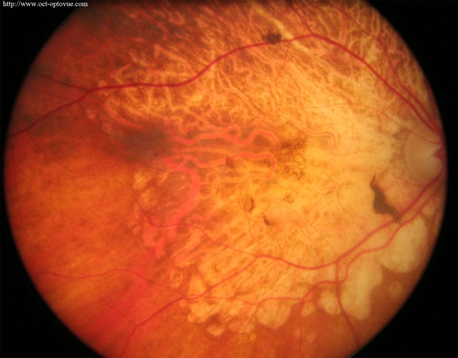 angio-atrophy retina oct