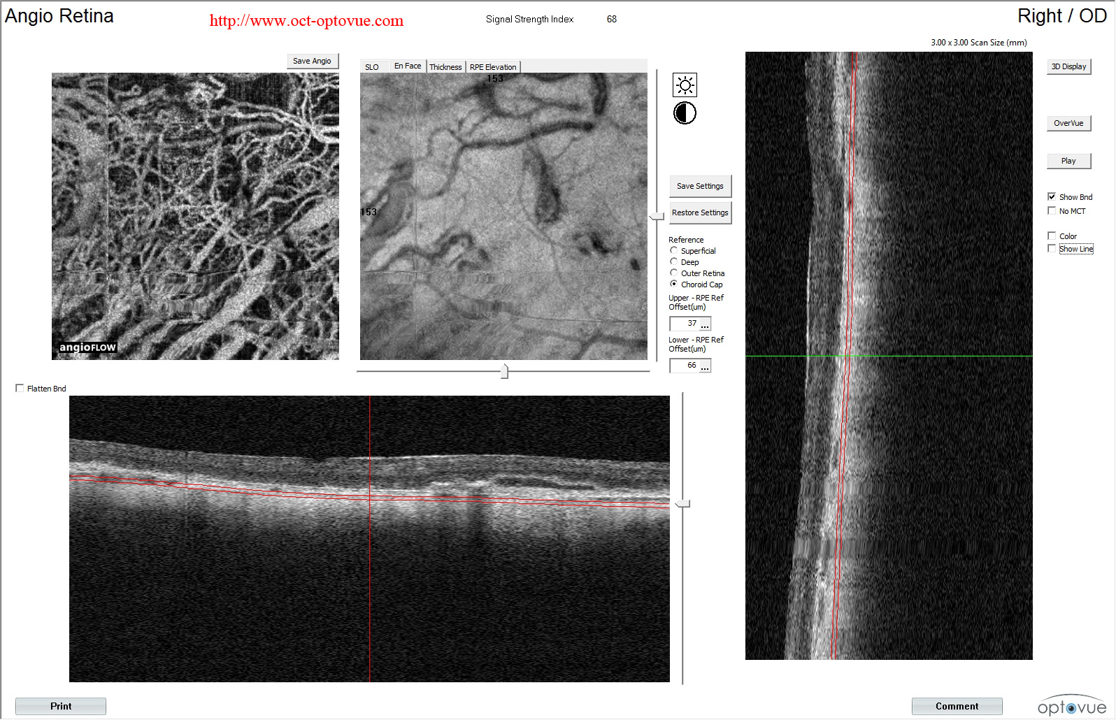 angiovue-atrophy-retina-amd armd