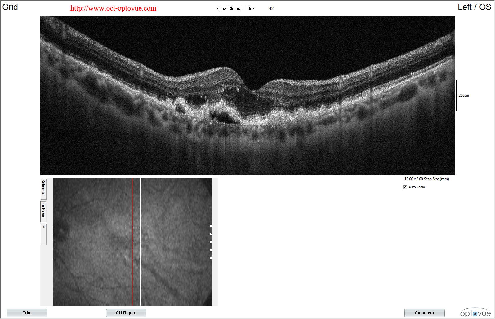 oct macular drusen amd angio druses maculaires