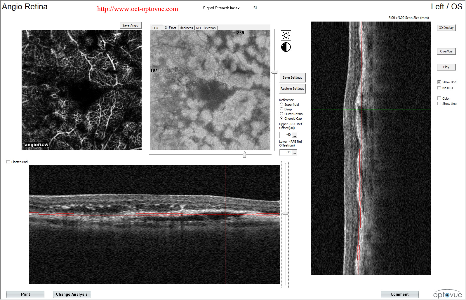 oct-drusen amd angio druses maculaires