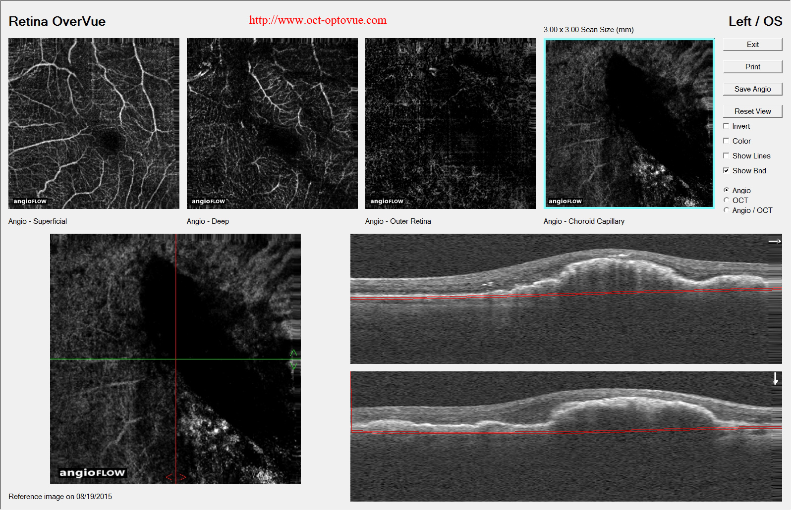 pigment-epithelial-tears OCT angiography