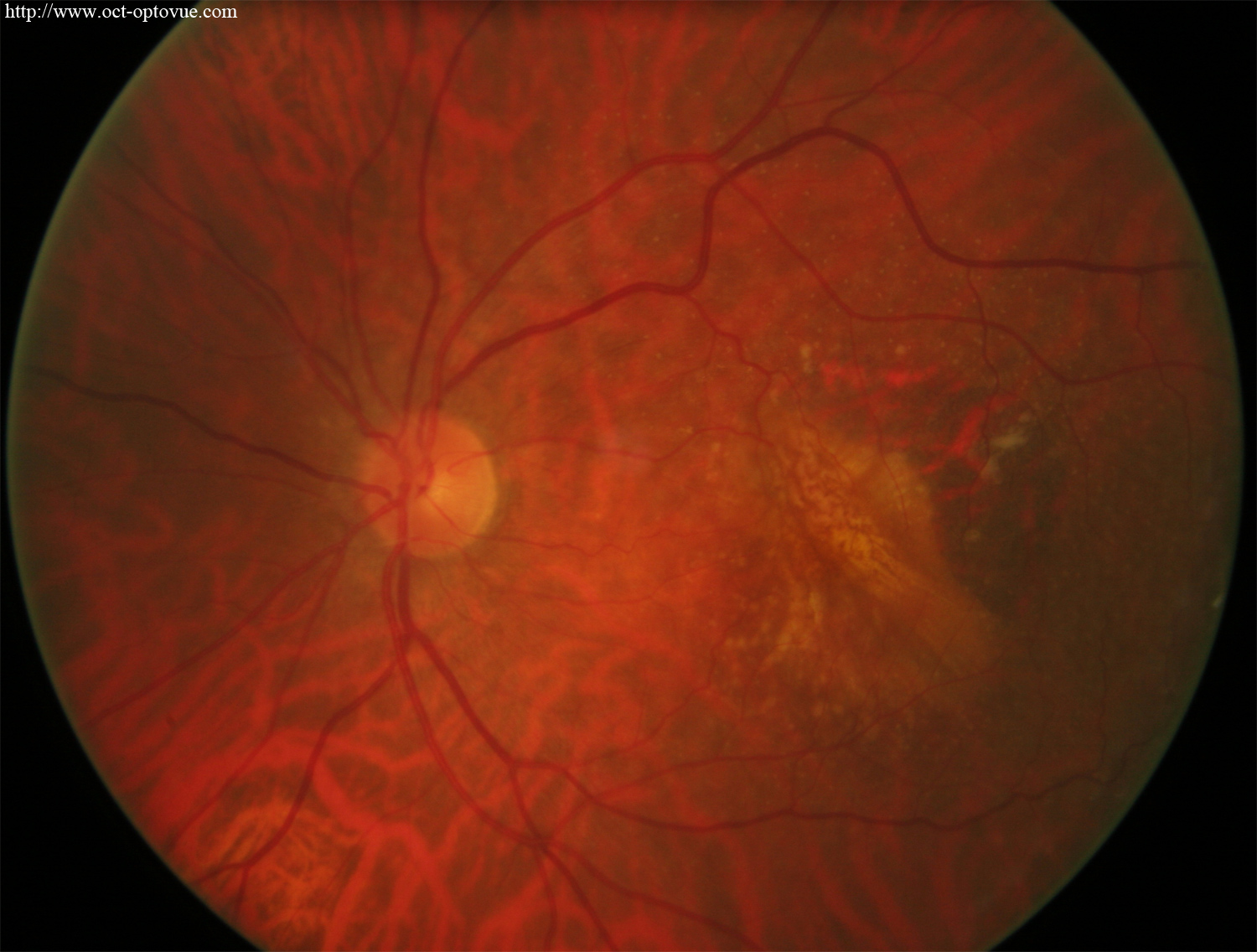 Retinal pigment epithelial tear post anti-VEGF