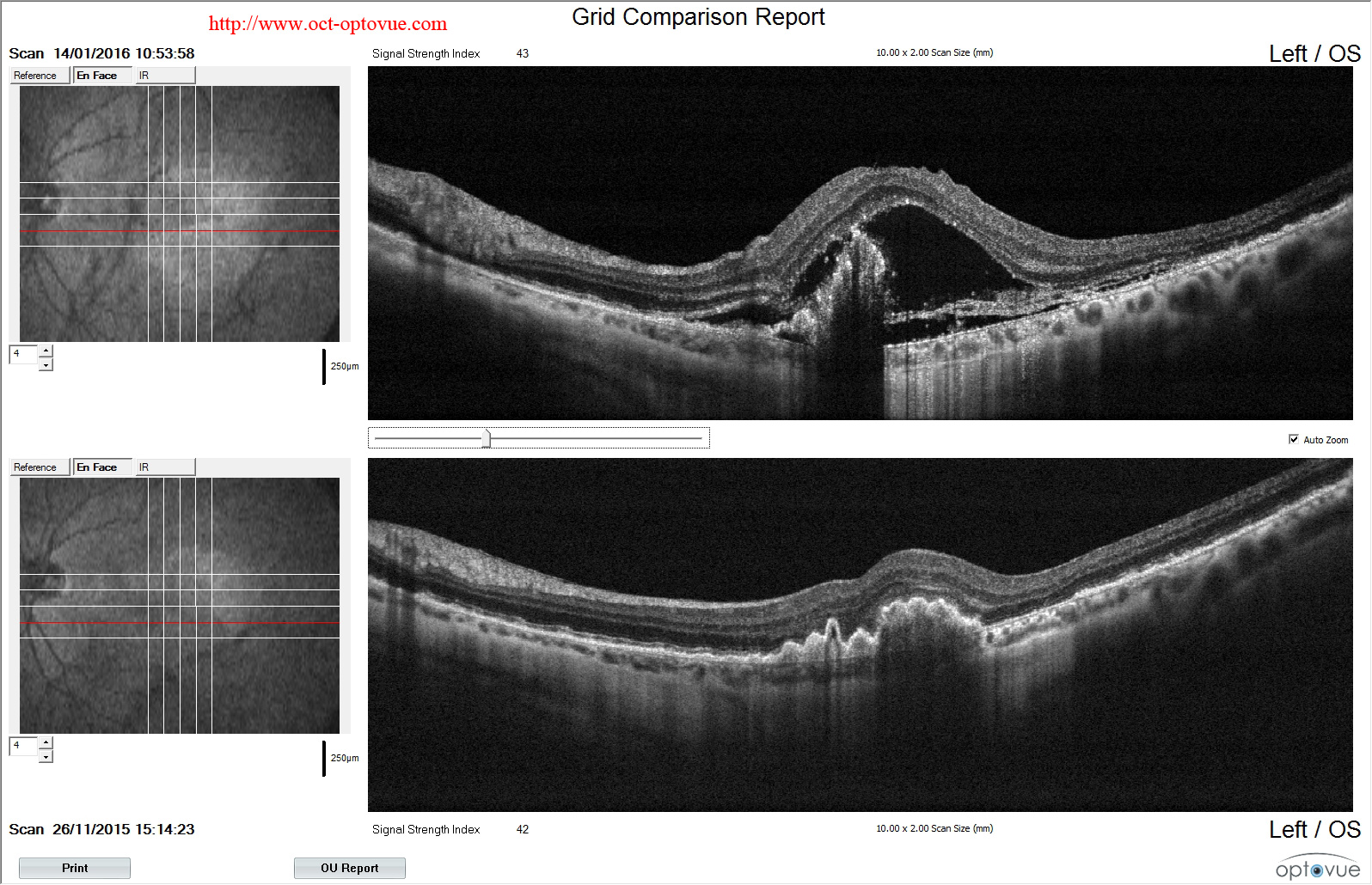 RPE-tears recurrence amd oct