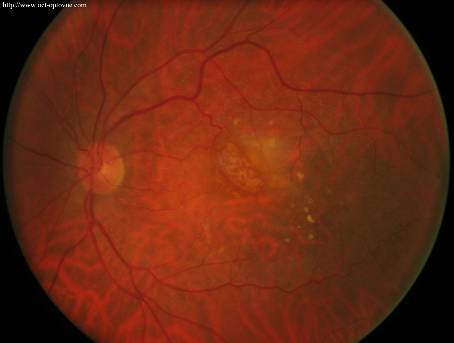 RPE-tears recurrence amd