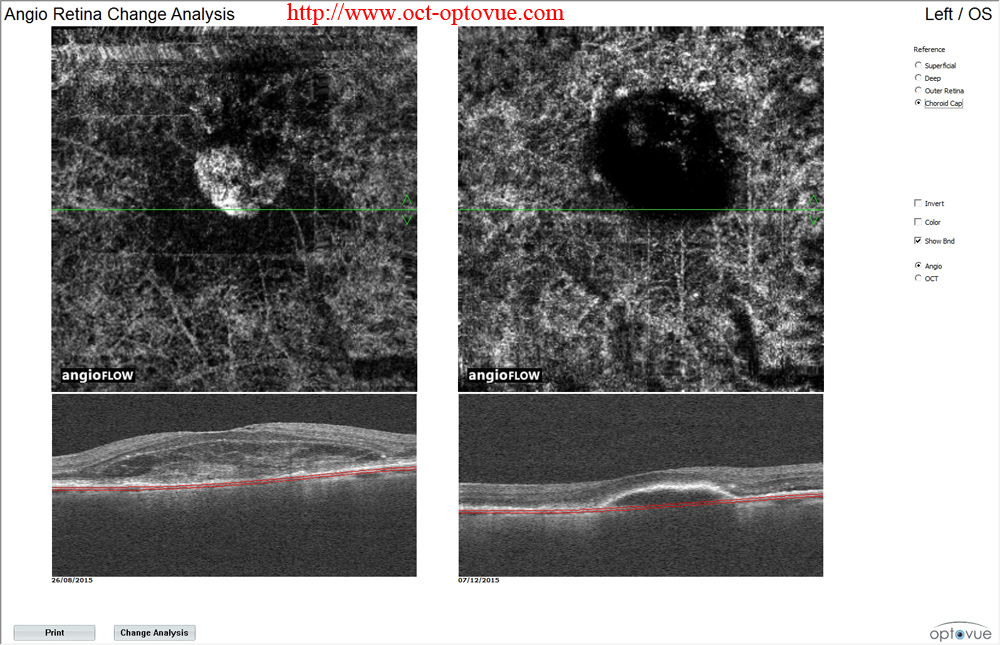angio-oct before post Lucentis Eylea amd dmla