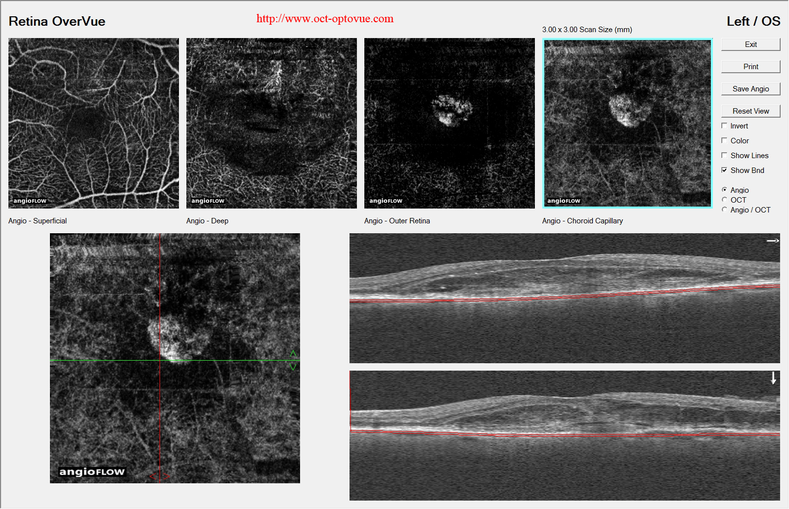 cnv-angiovue amd exsudative