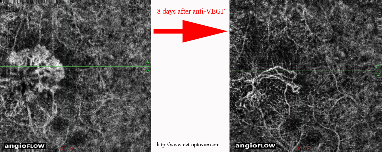 angio-oct antivegf lucentis eyelea