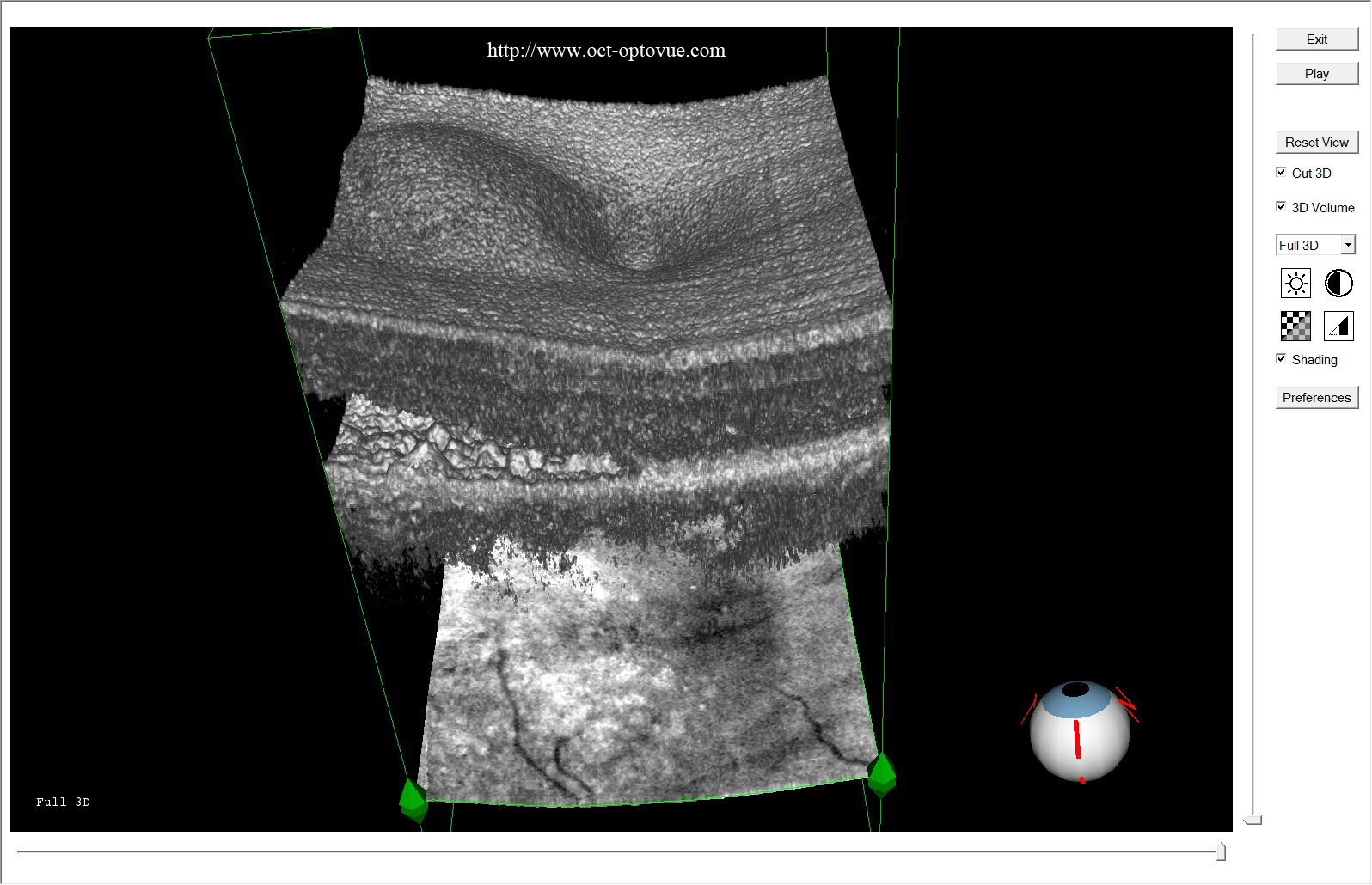 armd 3d angiovue dmla armd néovaisseau