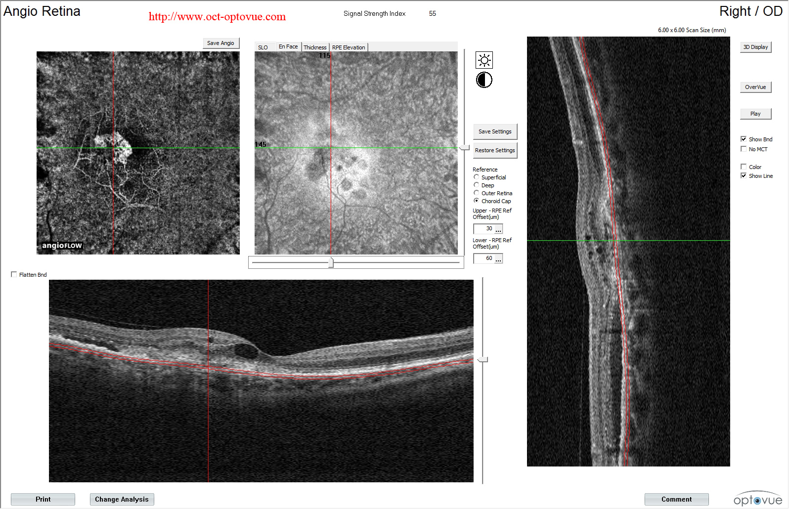 armd angiovue armd angiography angioct dmla