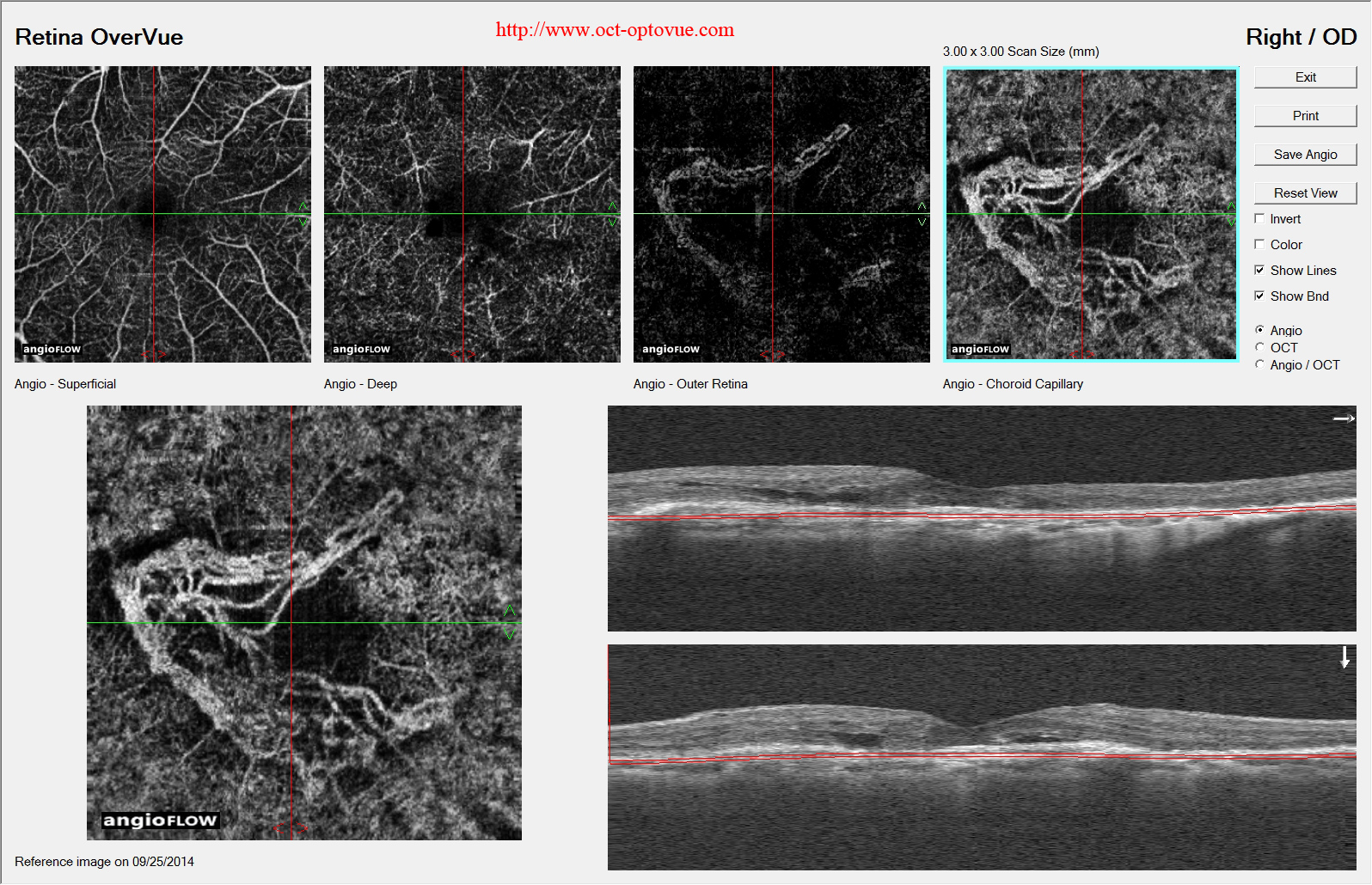 armd angiovue vessels lucentis eylea anti-vegf