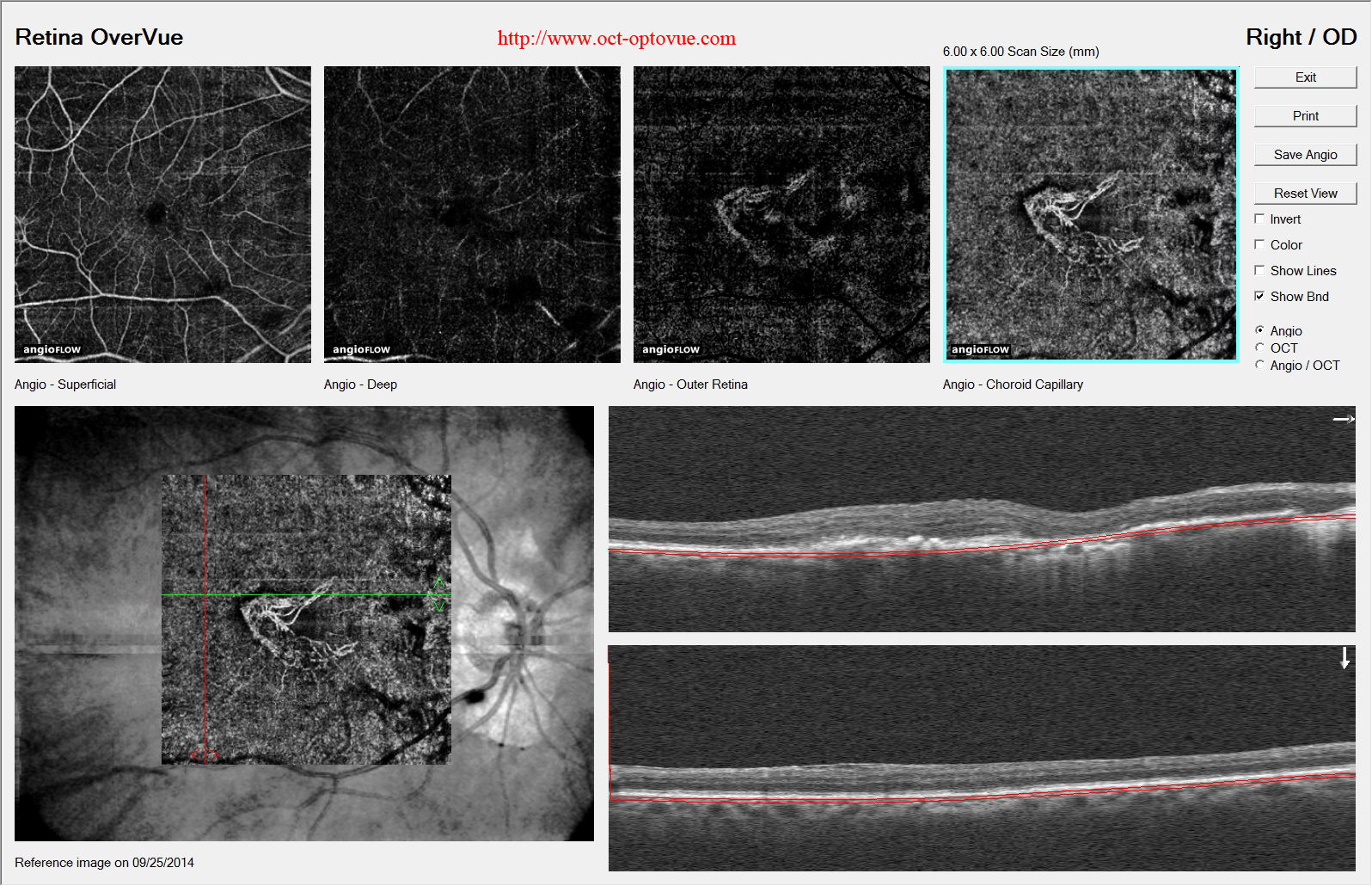 armd angiovue angioOCT retina dmla lucentis eylea