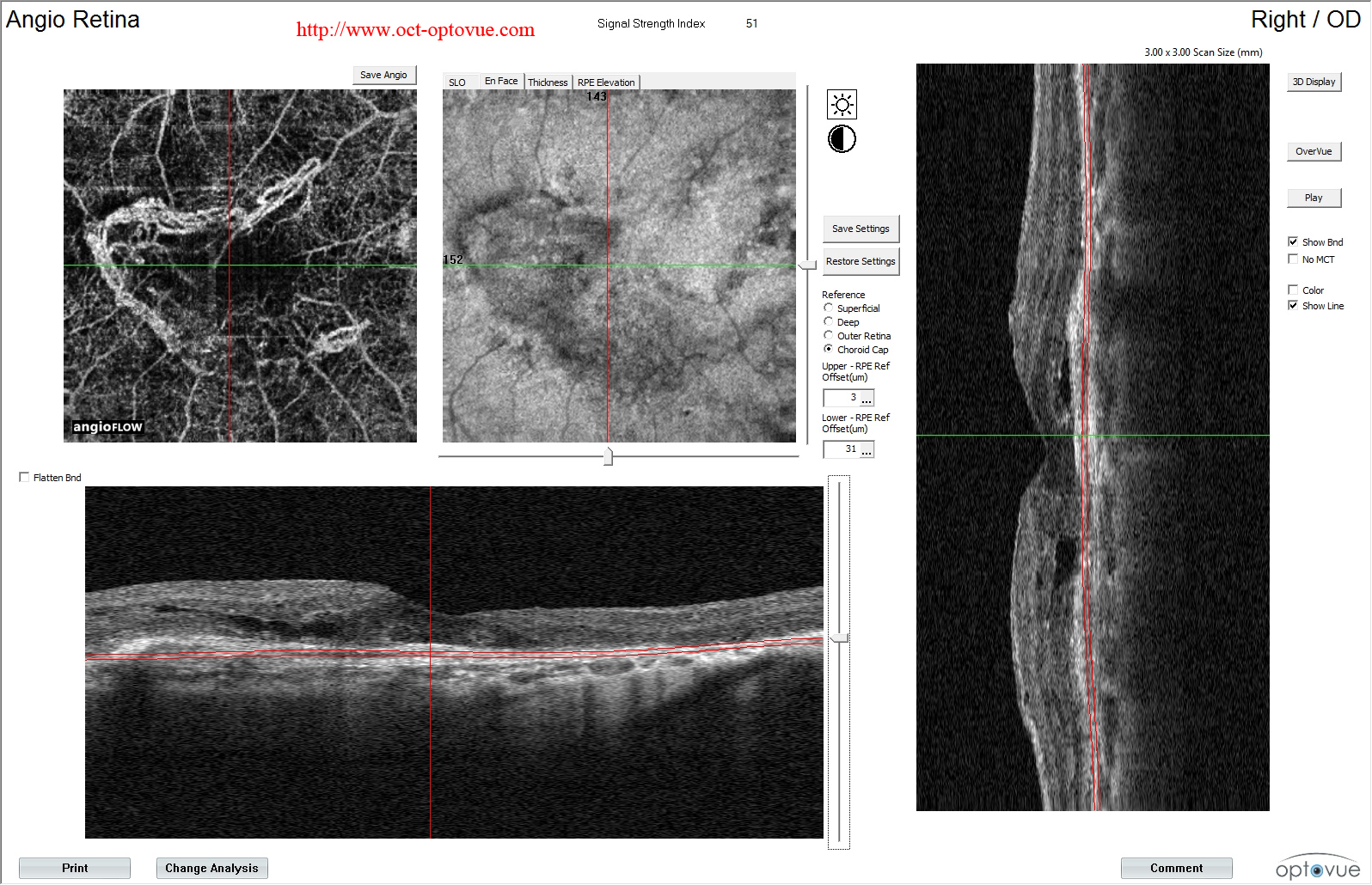 armd angiovue angio-OCT retine dmla lucentis eylea