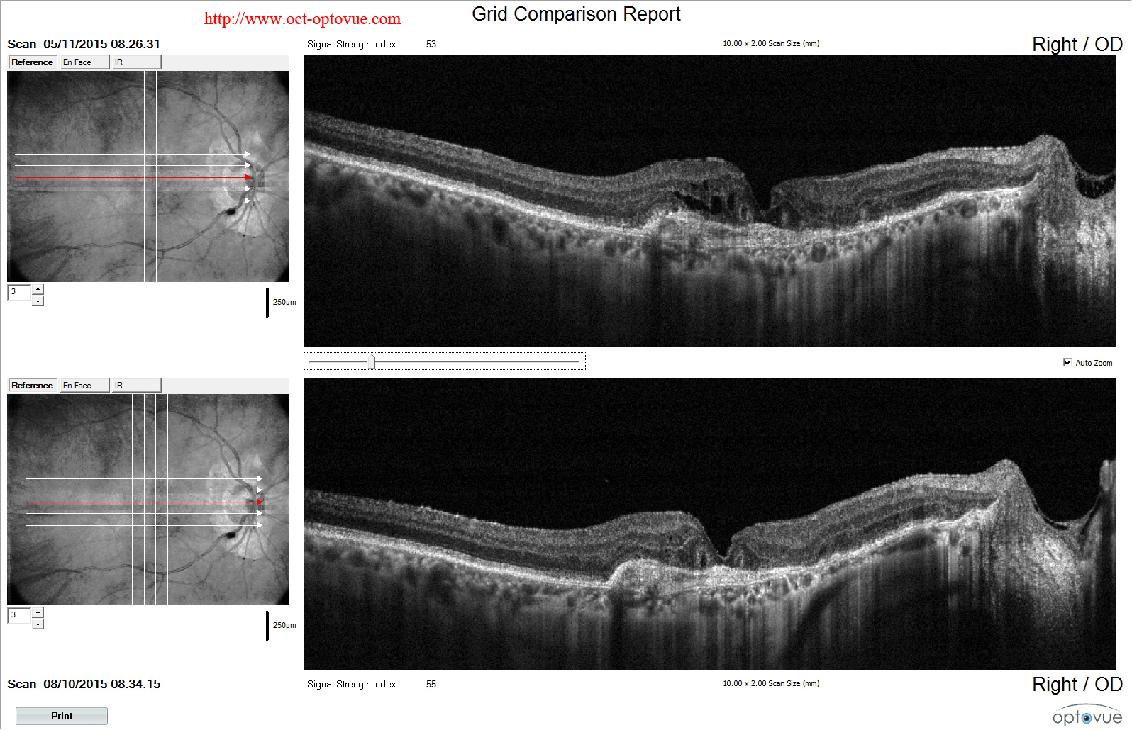 oct recurrent cnv retina recurrence