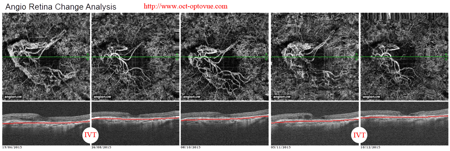 octa-new-cnv recurrence neovaisseaux