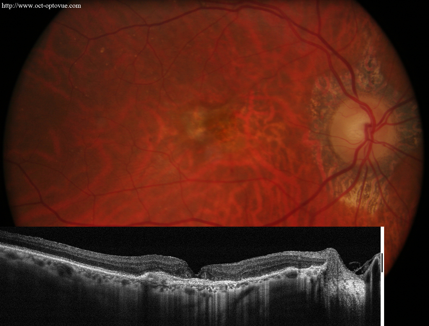 recidive amd dmla oct angiography