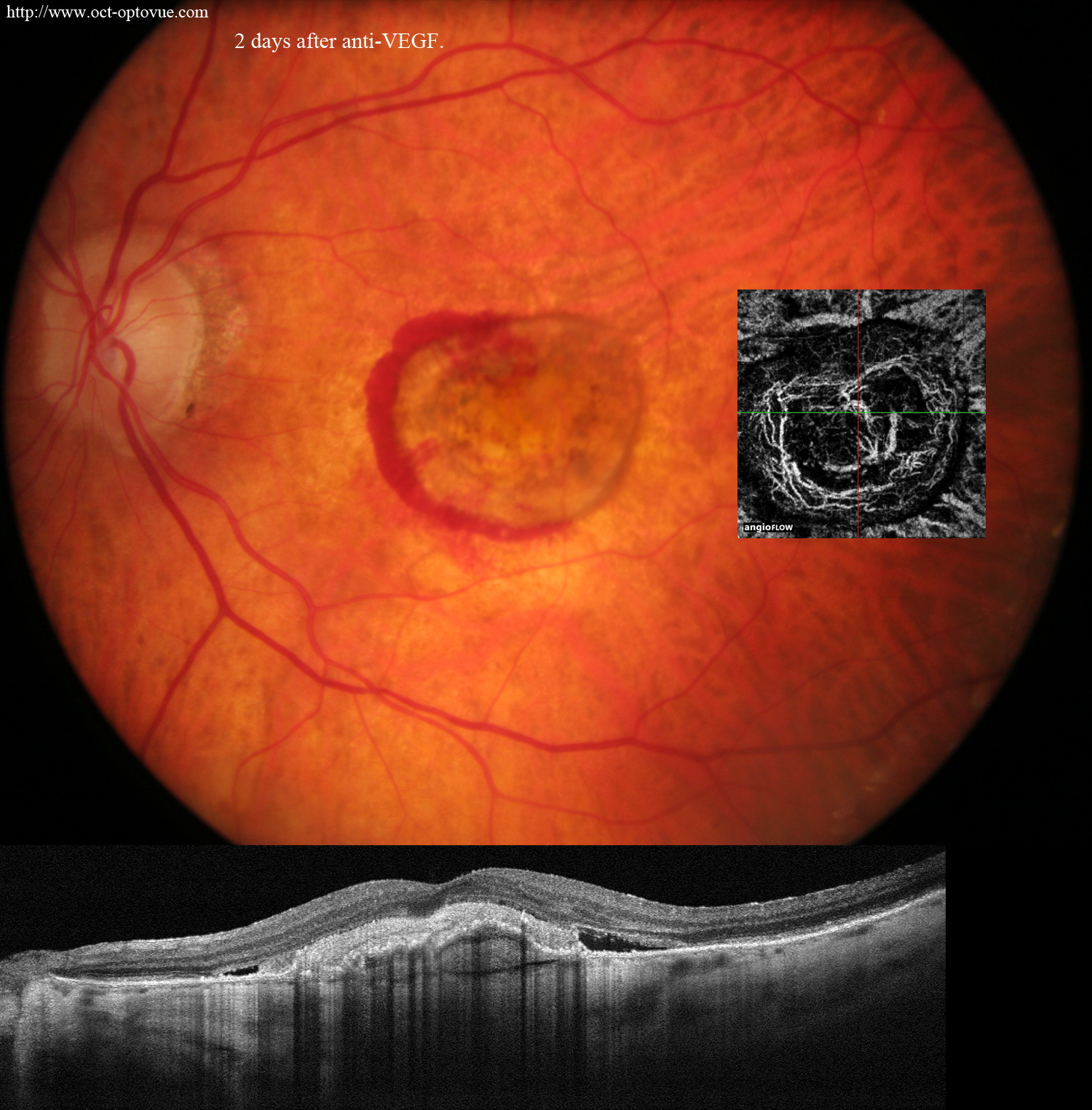 2-days anti-vegf lucentis eyelea