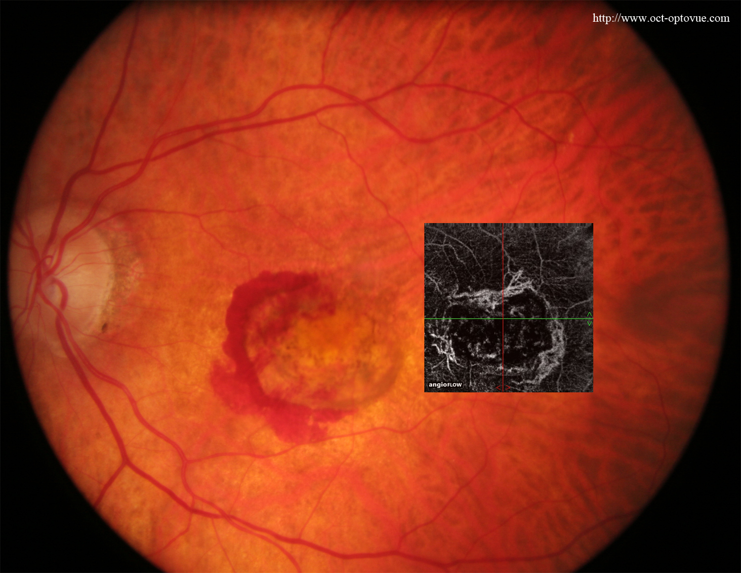 angiovue hemorrhage retina dmla armd lucentis eyelea