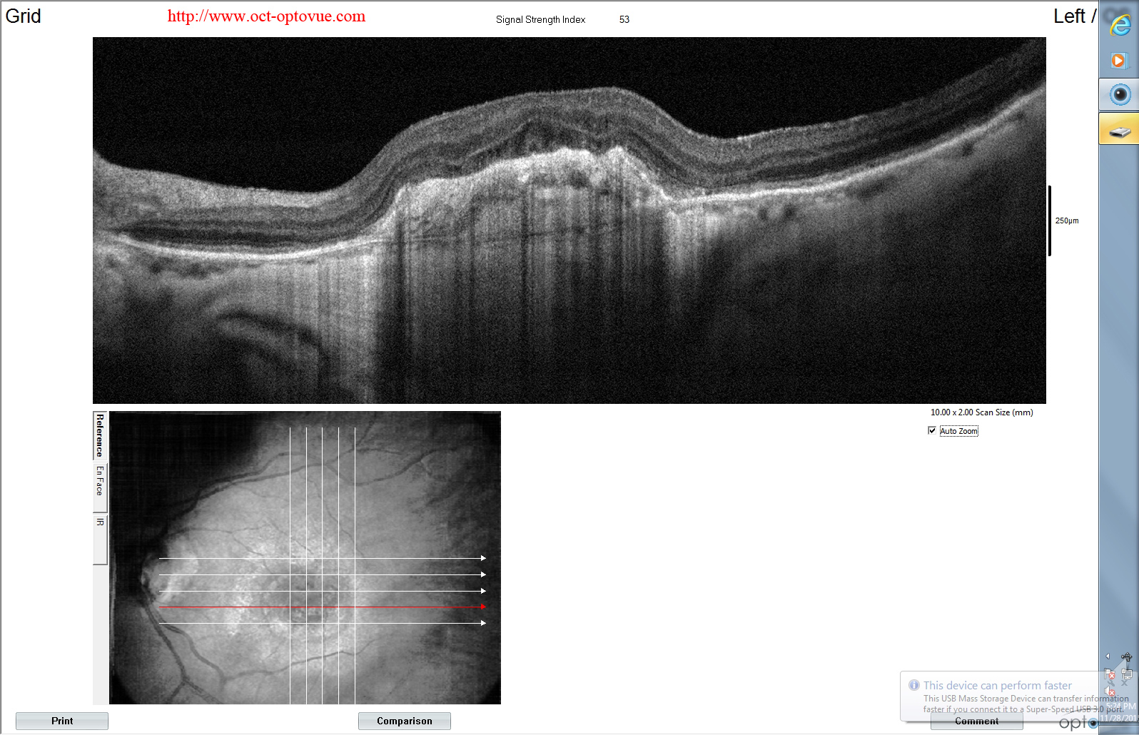 arterialisation-cnv optical coherence tomography