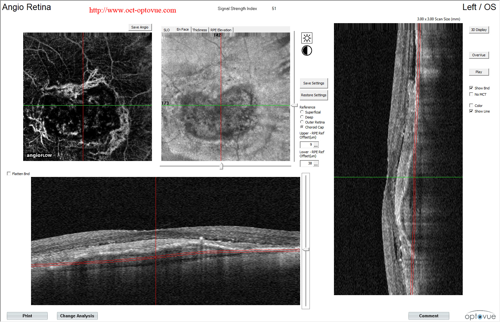 octangio  retina hemorrhage oct-angiogrraphy