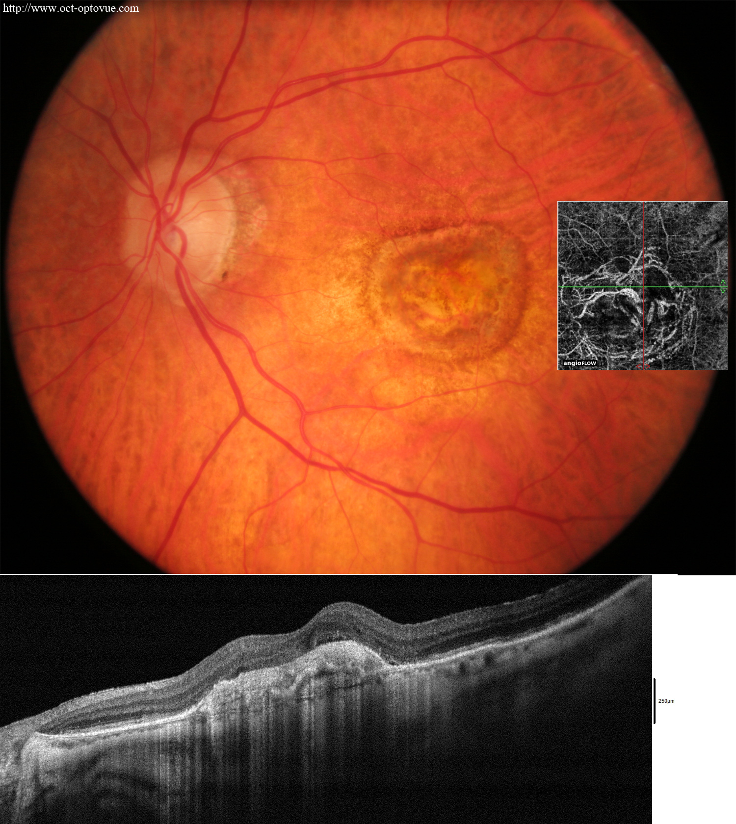 scar-after-anti-vegf lucentis eyelea