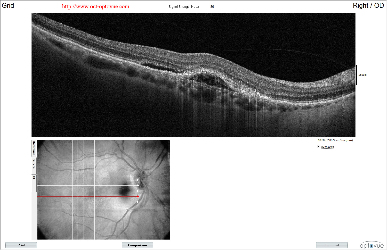 armd angiovue amd recidive dmla